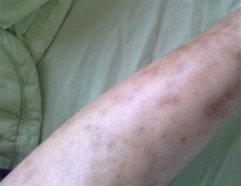 Bệnh viêm mạch máu có nhiều triệu chứng khác nhau, rất khó chẩn đoán