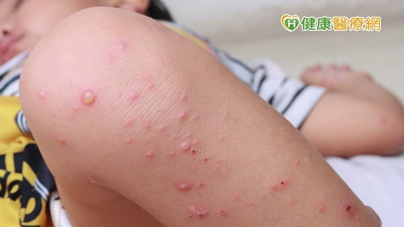 Bệnh tay chân miệng không có thuốc điều trị, nên cảnh giác các biến chứng nặng