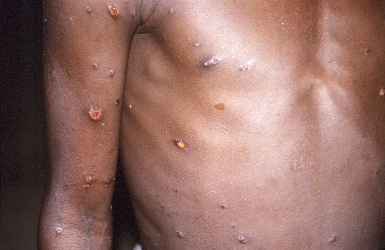 Dịch bệnh Mpox đang lan rộng. Chuyên gia: Sớm muộn sẽ tràn vào Đài Loan, e rằng sẽ gây ra một đợt bùng phát dịch bệnh