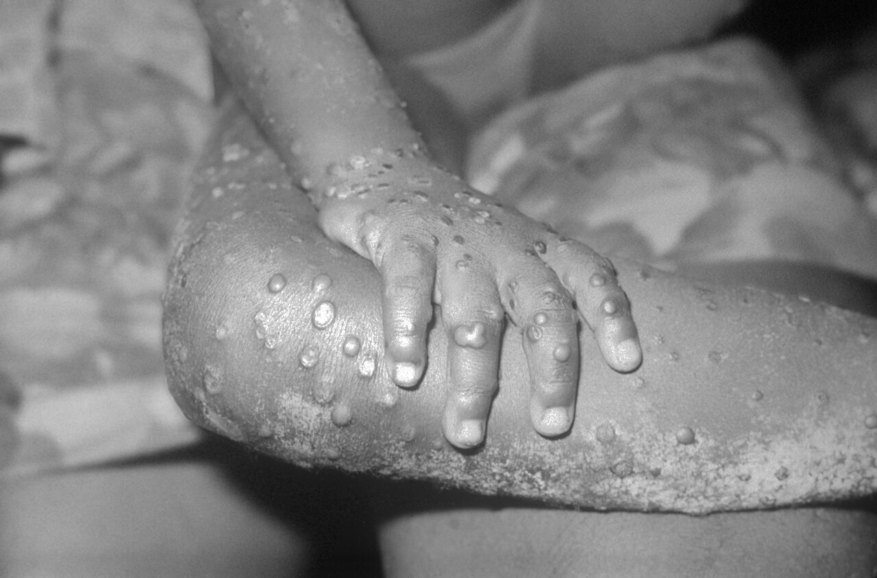 Đài Nam có 3 trường hợp mắc bệnh đậu mùa khỉ, người bệnh có tiếp xúc gần với người không xác định